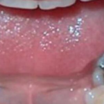 Evo šta se dešava ljudima koji imaju crne plombe