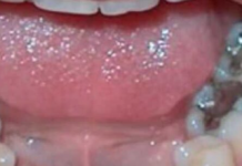 Evo šta se dešava ljudima koji imaju crne plombe