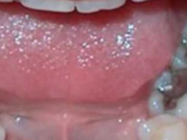 Evo šta se dešava ljudima koji imaju crne plombe