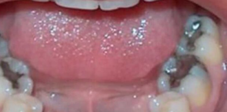 Evo šta se dešava ljudima koji imaju crne plombe