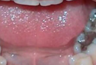 Evo šta se dešava ljudima koji imaju crne plombe