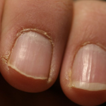 IMATE LI OVAKVE IZBOČINE NA NOKTIMA – evo šta one znače: Doktorica otkrila, obratite pažnju