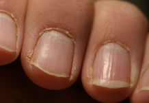 IMATE LI OVAKVE IZBOČINE NA NOKTIMA – evo šta one znače: Doktorica otkrila, obratite pažnju