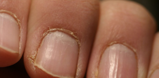 IMATE LI OVAKVE IZBOČINE NA NOKTIMA – evo šta one znače: Doktorica otkrila, obratite pažnju