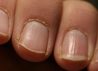 IMATE LI OVAKVE IZBOČINE NA NOKTIMA – evo šta one znače: Doktorica otkrila, obratite pažnju