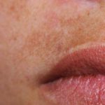 Fleke na koži – Zašto se pojavljuju i kako ih se rešiti