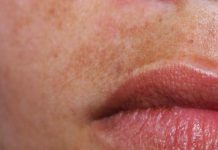 Fleke na koži – Zašto se pojavljuju i kako ih se rešiti