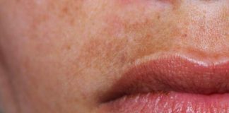 Fleke na koži – Zašto se pojavljuju i kako ih se rešiti