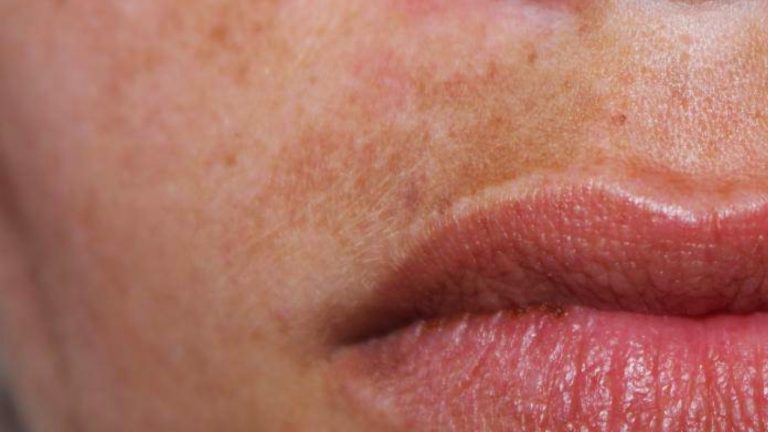 Zasto-se-pojavljuju-fleke-na-kozi-i-kako-ih-se-resiti-768x432