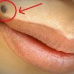 OTKRIJTE ISTINU Šta znači ako imate mladež na licu, ruci ili stopalu