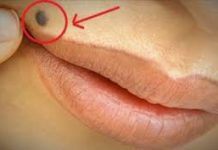 OTKRIJTE ISTINU Šta znači ako imate mladež na licu, ruci ili stopalu