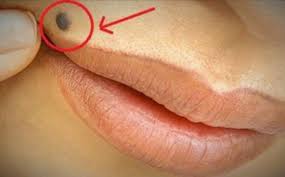 OTKRIJTE ISTINU Šta znači ako imate mladež na licu, ruci ili stopalu