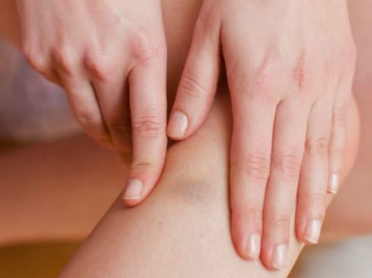 Primijetili ste da vam lako ostaju modrice na tijelu? Evo šta mogu biti uzroci