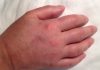 Prsti vam stalno otiču? Odmah kod lekara, može biti simptom opasne bolesti