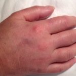 Prsti vam stalno otiču? Odmah kod lekara, može biti simptom opasne bolesti