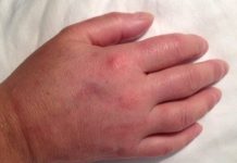 Prsti vam stalno otiču? Odmah kod lekara, može biti simptom opasne bolesti