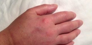 Prsti vam stalno otiču? Odmah kod lekara, može biti simptom opasne bolesti