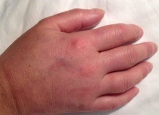 Prsti vam stalno otiču? Odmah kod lekara, može biti simptom opasne bolesti